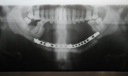 Figure 7: Photograph showing postoperative Orthopantomogram showing the ostoeotomised fibula used for reconstruction.